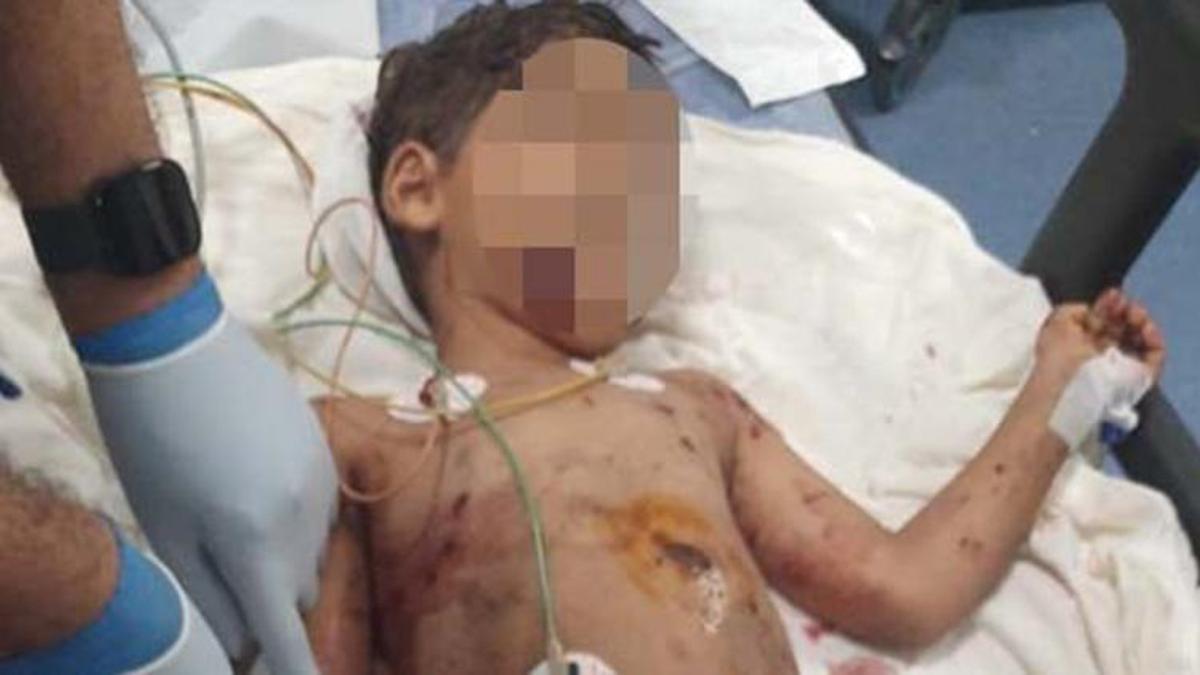 Adana'da bir çocuk sokak köpeğinin saldırısına uğradı