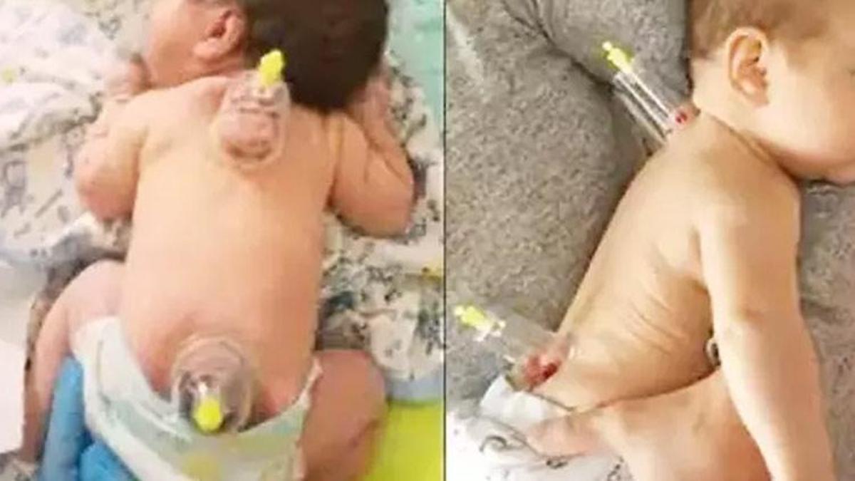 Ölüme kadar götürebilir! El kadar bebeklere hacamat yapıyorlar