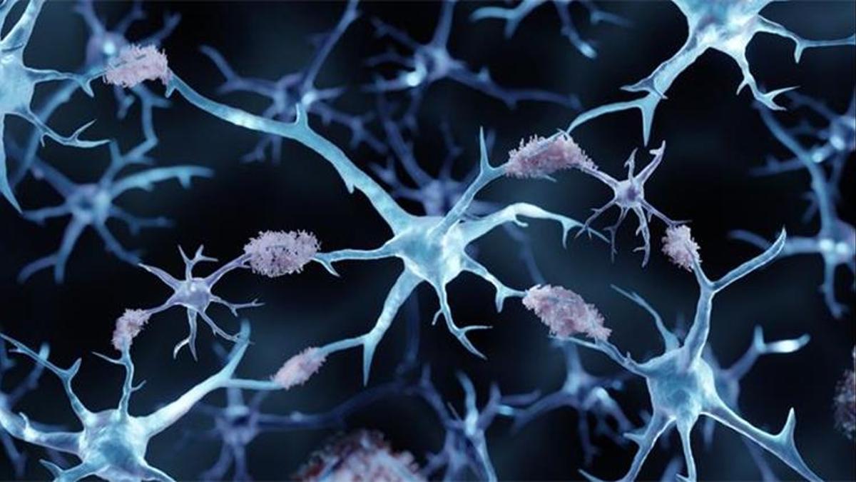 Avrupa Birliği Alzheimer hastalarına derman olacak ilaca onay vermedi! Bilişsel zayıflamayı yüzde 25 oranında yavaşlatıyor