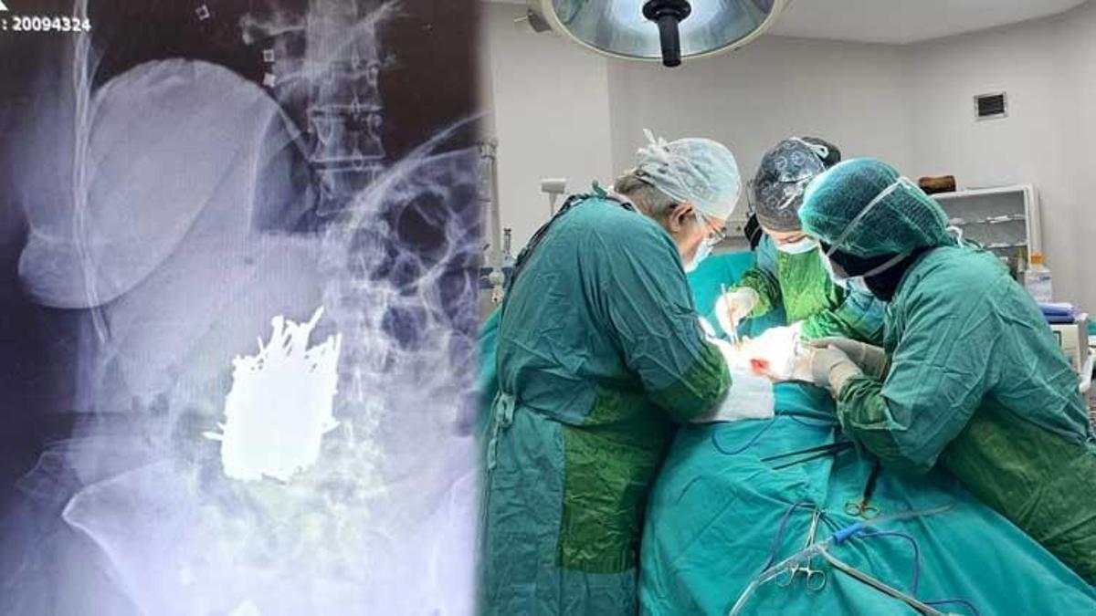 Karın ağrısı şikayetiyle gitti, midesinden 1 kilo metal çıktı!