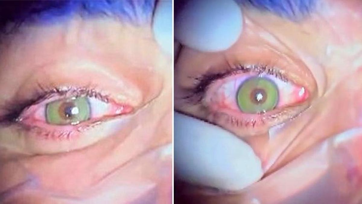 Göz rengini değiştirmek bir ameliyatla mümkün! Lazer destekli yeni yöntemler kalıcı sonuç veriyor