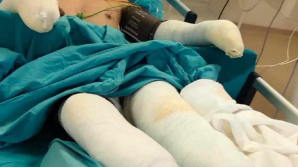 Orman yangınına müdahale sırasında ağır yaralanan eşinin son halini paylaştı