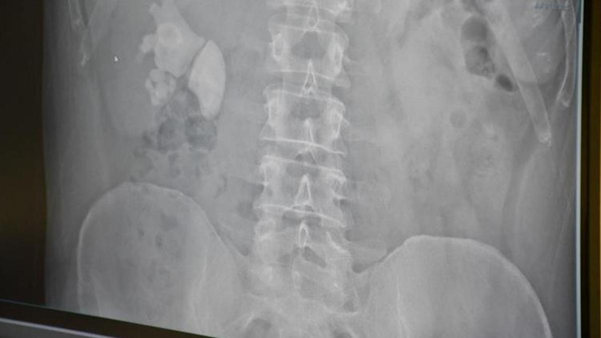 Ağrı şikayetiyle hastaneye gitti! Doktorlar dondu kaldı: 100 tane birden çıktı