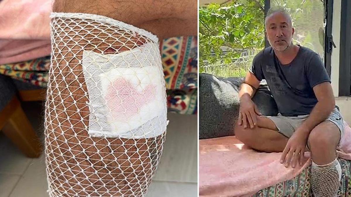 Muğla'da köpek saldırısına uğrayan vatandaşın bacağına 5 dikiş atıldı! Belediyeden şikayetçi oldu