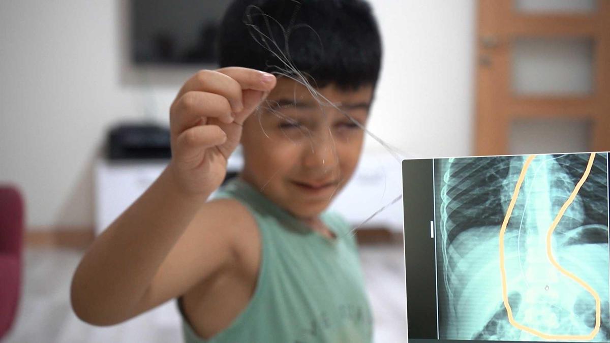 Salatalık yutunca rahatsızlandı, 3 yıl önce vücudunda tel unutulduğu ortaya çıktı! 'Kalbine ve ciğerlerine zarar vermiş'