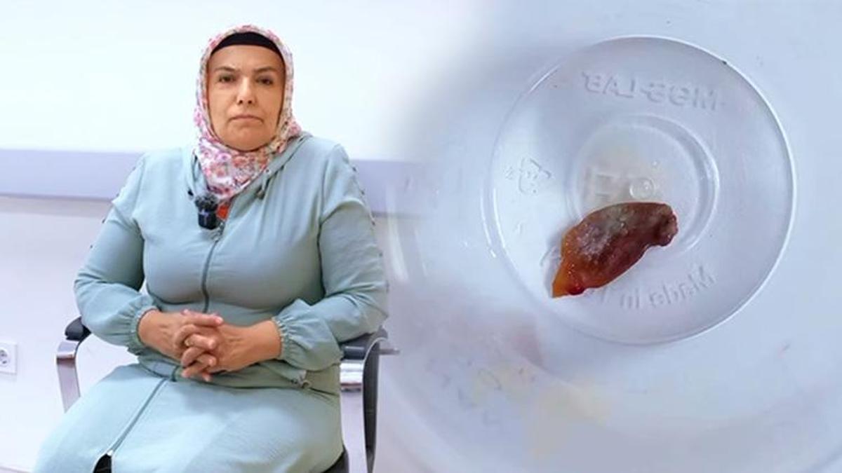 Malatya'da bir buçuk yıldan beri öksüren hastanın akciğerinde kabak çekirdeği bulundu!
