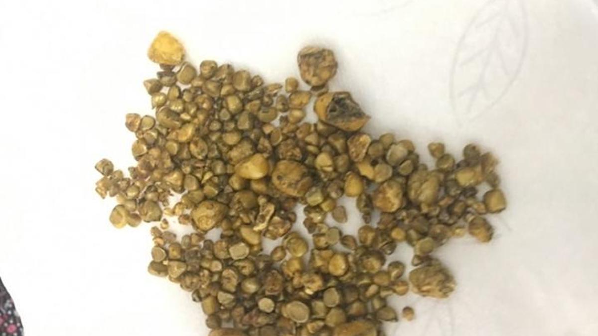 Safra kesesi taşından ameliyat olmadan kurtulan var mı?