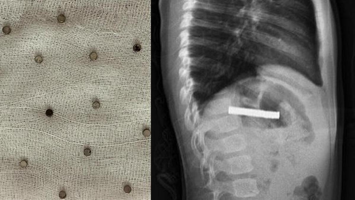 Erzurum'da 3 yaşındaki çocuğun yuttuğu 19 mıknatıs Elazığ'da endoskopiyle çıkarıldı