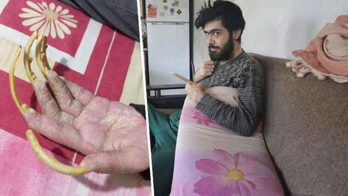 Telefon bağımlısı gencin içler acısı hali! Hatay'daki evinden 3 yıldan beri hiç çıkmadı