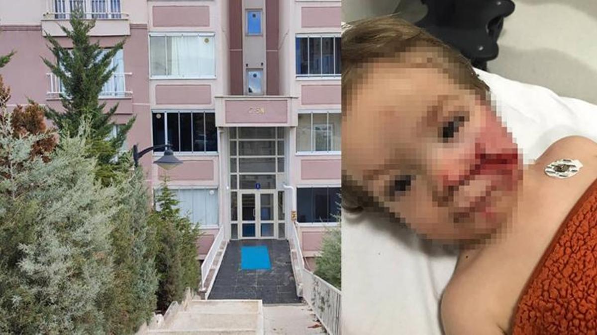 Ankara'da 2 çocuğu yaralayan pitbull cinsi köpeğin sahibi tutuklandı