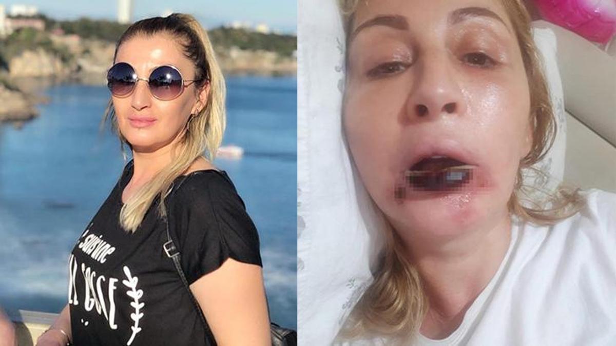 Estetik yaptırdı hayatı karardı! İşlem sonrası dudağı çürüdü, 7 yıldır çare arıyor