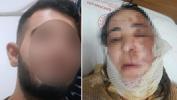 Üvey evlat dehşeti! Evlenmesin diye yüzüne kezzap döktü
