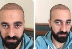 Saç ektirince sözleşmesi feshedildi