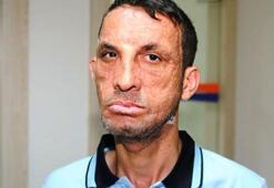 İlk yüz nakilli Uğur Acar'a 'cinayet' davasından beraat