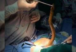 Herkes şoka girdi! Anüsünden yılan balığı çıktı