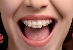 Diş teli temizliği nasıl yapılır?