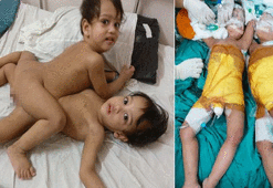 12 saat sürdü, 20 doktor ayırdı!
