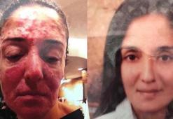 "Yüze kezzap atma soruşturması"nda takipsizlik