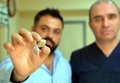 Doktorları bile şaşırttı! 3 santimetre çapında taş
