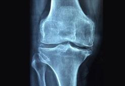Osteoporoz 3 kadından birini kıskacına alıyor