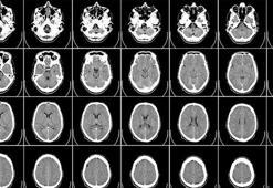 Obez çocukların beyinlerinde yapısal farklılıklar gözlendi
