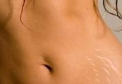 Fibroderms ile vücut çatlaklarına son