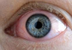 Gözyaşı kanal tıkanıklığına dikkat