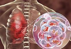 KOAH (Kronik Obstrüktif Akciğer Hastalığı) hastalığı nedir? Kimler KOAH adayıdır, nasıl tedavi edilir?