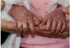 Tüm vücudu altüst eden hastalık: Lupus