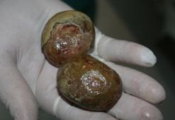 Mesanesinden 293 gram ağırlağında 2 taş çıkarıldı