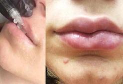 Doktorlar bile şoke oldu! Estetik uğruna dudağı yamuldu