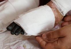 Nadir hastalık kız çocuğunu eve mahkum etti!