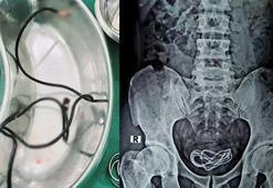 Tıp dünyası şaşkın! Mesanesinden bir metre uzunluğunda şarj kablosu çıktı