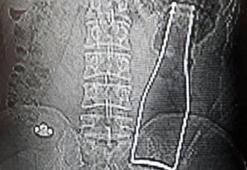 Doktorlar şaşkına döndü! Bağırsağından soda şişesi çıktı