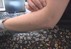 İstanbul'a sivrisinek kabusu! Hastanelere akın ettiler...