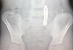 Doktorlar bile şaşırdı! 42 tane mıknatıs yuttu