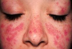 Kelebek Hastalığı nedir nasıl oluşur? Kelebek hastalığı (Lupus) bulaşıcı mı? Kelebek hastalığı belirtileri