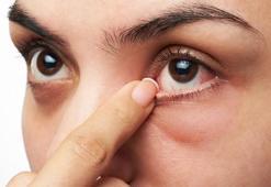 'Göz uçuğu körlüğe yol açabilir'