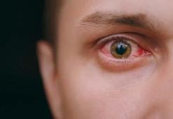 Adenovirüs nedir? Adenovirüsler gözü nasıl etkiler, görme kaybına neden olur mu? Covid-19 kadar hızlı yayılabiliyor!