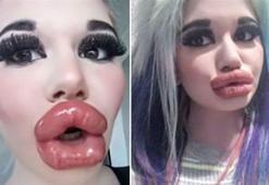 Barbie’ye özenip 20’den fazla dudak dolgusu yaptırdı