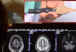 Akılalmaz olay! Doktor fark etmedi, 1 gün boyunca böyle gezdi