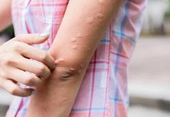 Sivrisinek sokmasına ne iyi gelir? Asya Kaplan Sivrisineği ısırığı nasıl geçer?