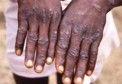 Maymun Çiçeği virüsü nedir? Maymun Çiçeği (Monkeypox) virüsü bulaşıcı mı, belirtileri nelerdir, salgına dönüşür mü?