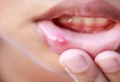 Behçet hastalığında yenmemesi gerekenler nelerdir?