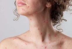 Çiçek hastalığı hala var mı, su çiçeği aynı şey midir?