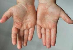 El ayak hastalığı neden olur, ne iyi gelir?