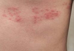 Zona hastalığı tehlikeli midir, bulaşıcı mıdır? Zona hastalığı tedavi edilmezse öldürücü müdür?