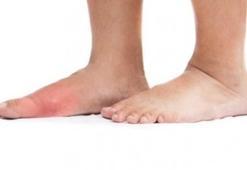 Gut hastalığına ne iyi gelir? Gut hastalığı olanlar ne yemeli?