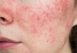 G&#252;l hastalığı olanlar nelere dikkat etmeli?