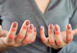 Kelebek hastalığı nedir? Lupus hastalığı belirtileri nelerdir?